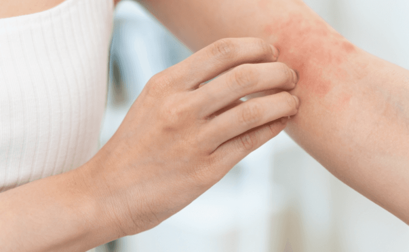 হঠাৎ করে ত্বকে ইরিটেশন হচ্ছে? কন্ট্যাক্ট ডার্মাটাইটিস নয় তো?